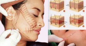 Phương pháp căng da, năng cơ mặt bằng chỉ