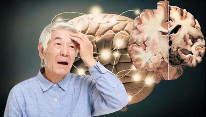 Suy giảm trí nhớ là bệnh gì?